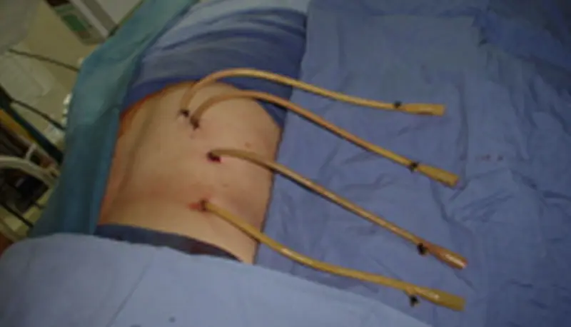 cirugía abierta, litiasis renal, dr edgar beltrán, urólogo, cdmx